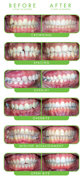 ClearCorrect Cases