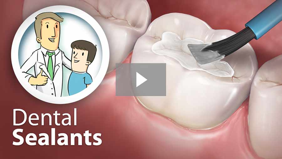 Dental sealants video
