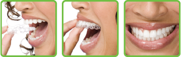 ClearCorrect Aligner