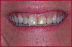 Before Dental Bonding