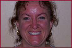 After Dental Implant